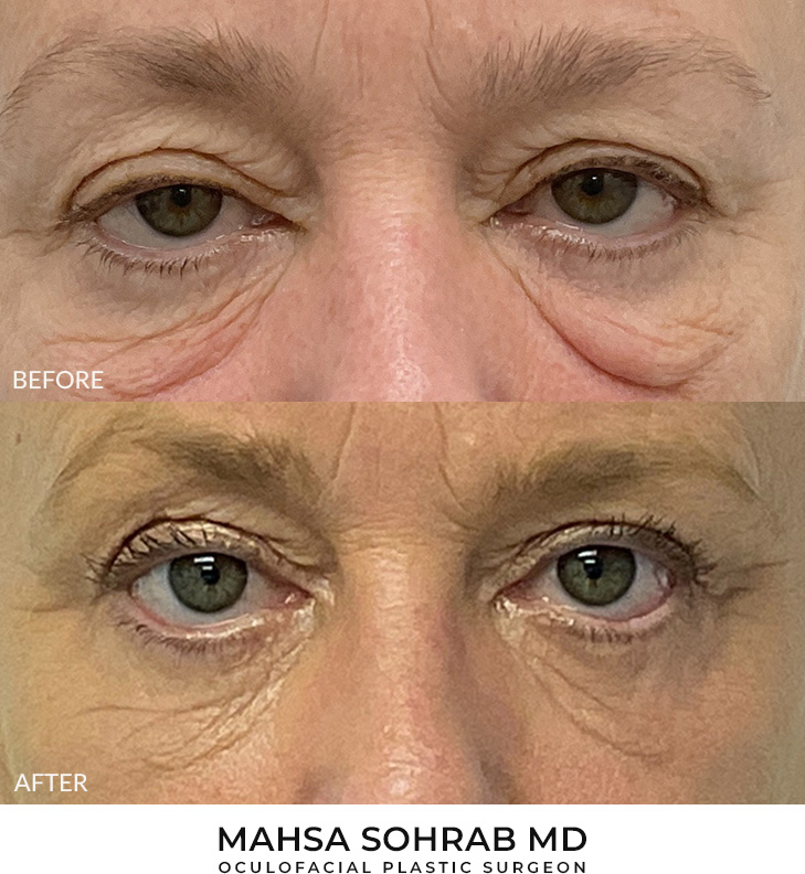 Lower Blepharoplasty Patient 08